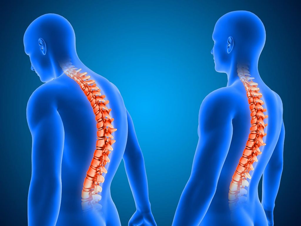 Kifoz Nedir? Belirtileri Nelerdir?